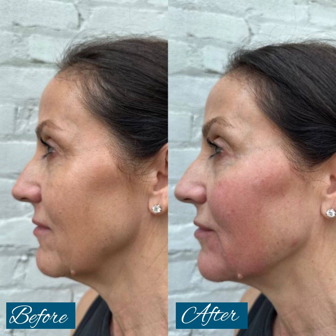 CHEEK AND JAW FILLER 1.2