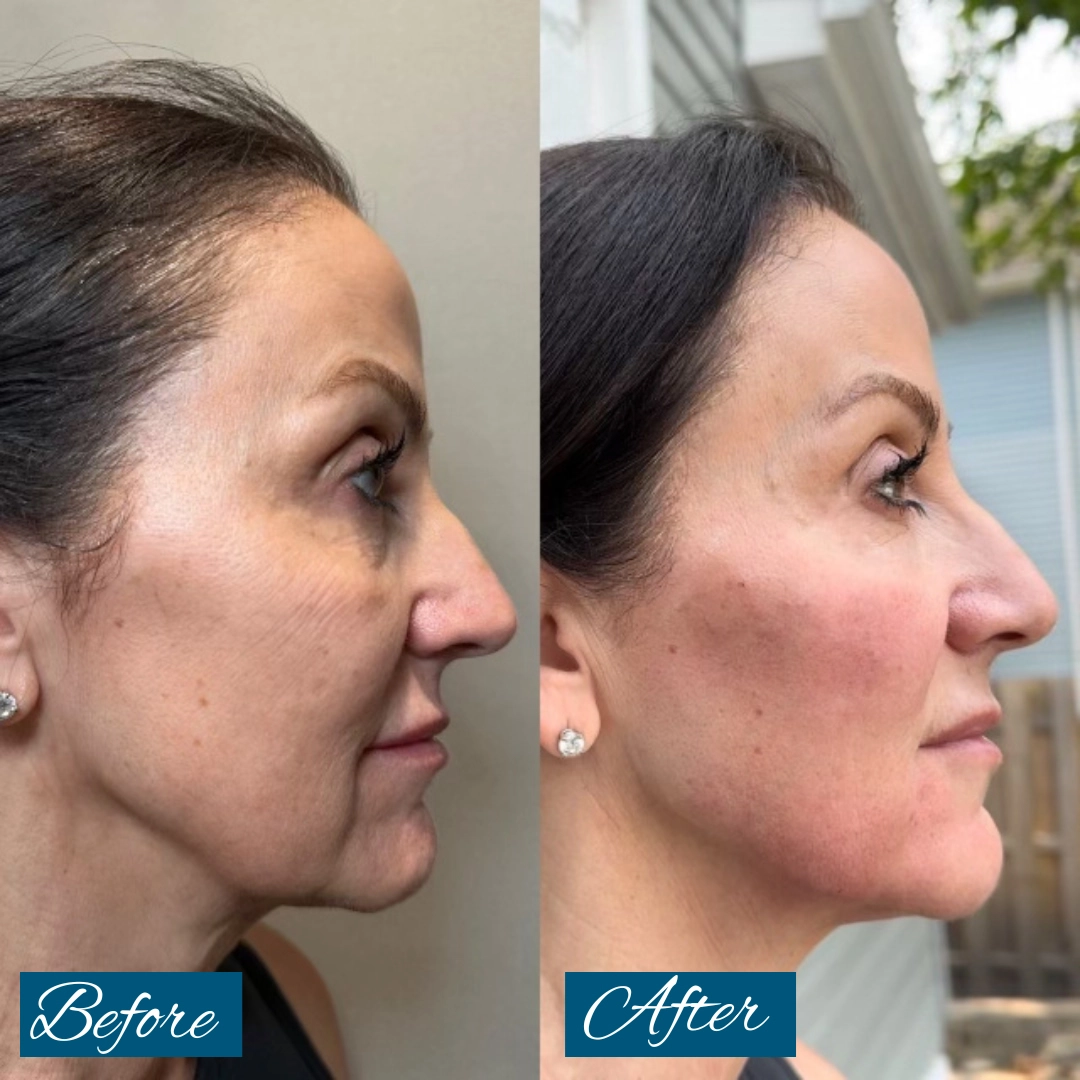 CHEEK AND JAW FILLER 1