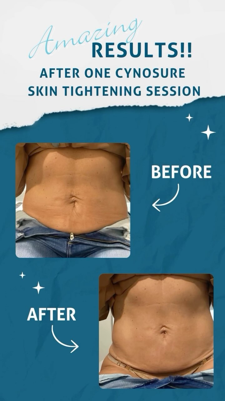 Cynosure skin tightening session