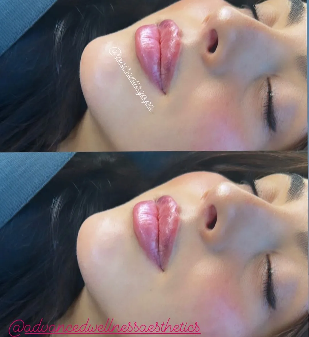 Lip filler case 2