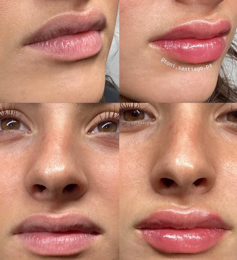 Lip filler case 3