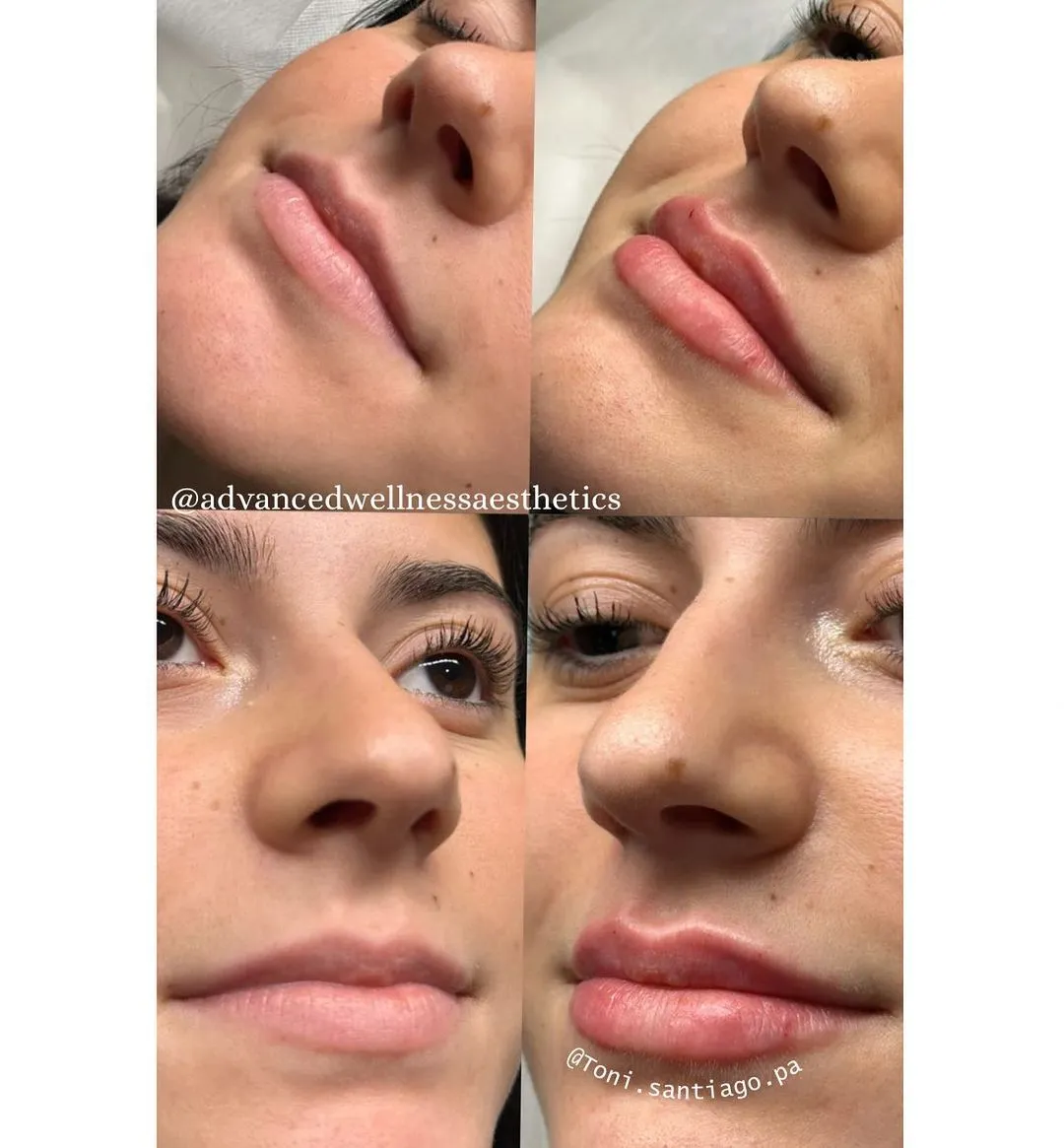 Lip filler case 4