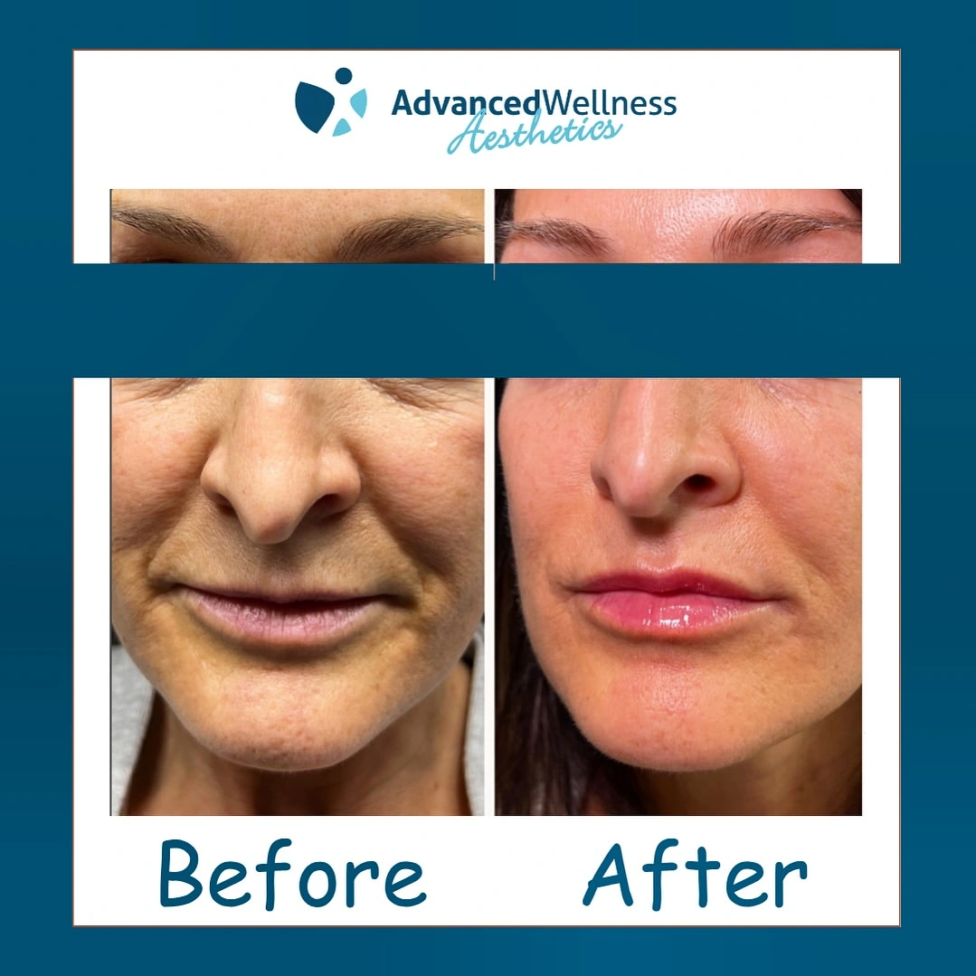 PDO thread case 1 and lip filler