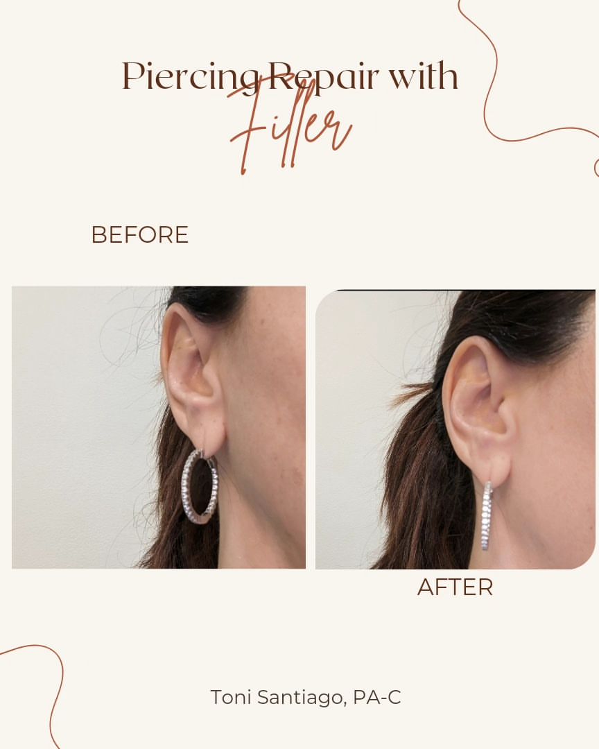 Peircing filler 1