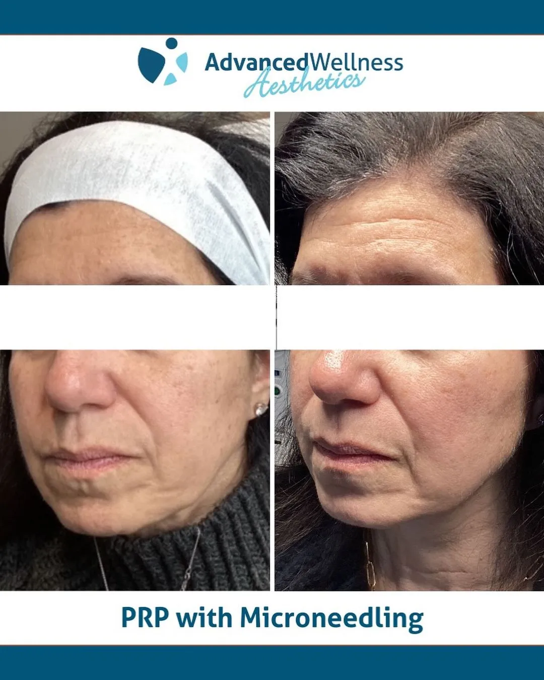 Platelet Rich Plasma (PRP) with microneedling 1