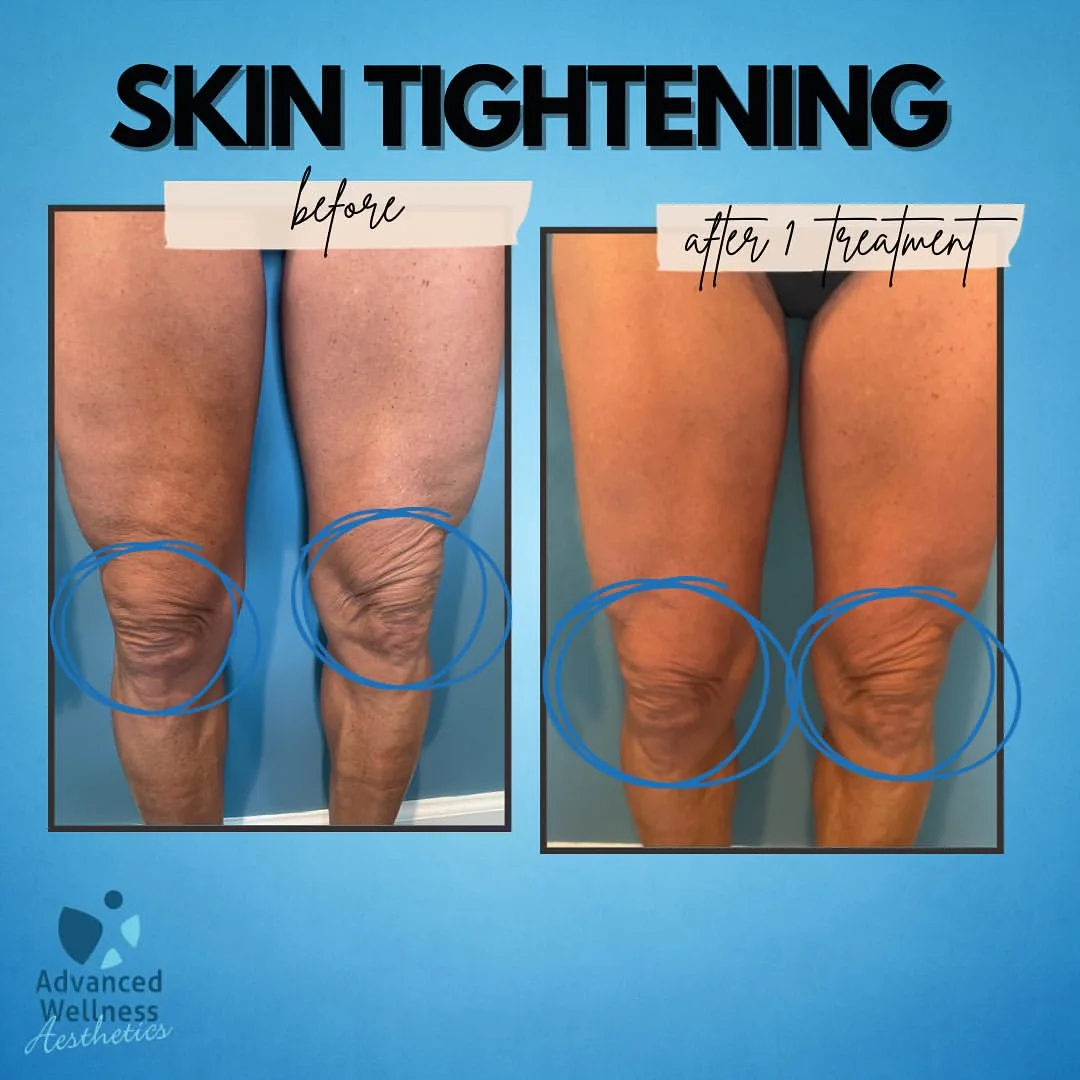 Skin tightening with radiofreq