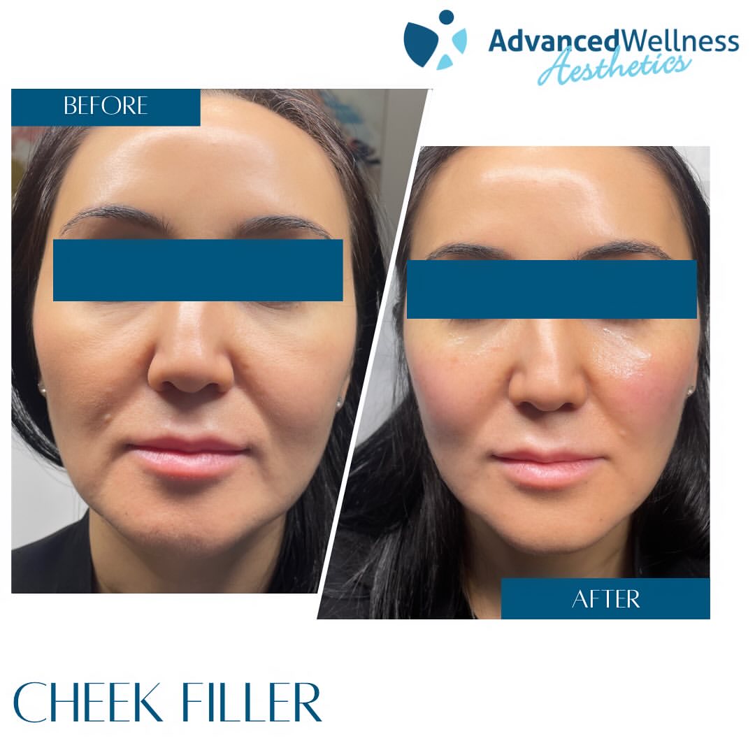 cheek lift 1.2