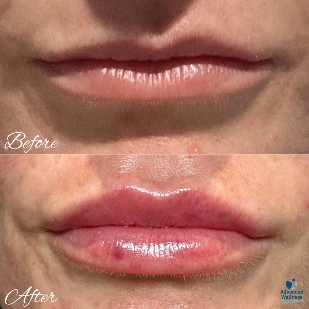 lip filler