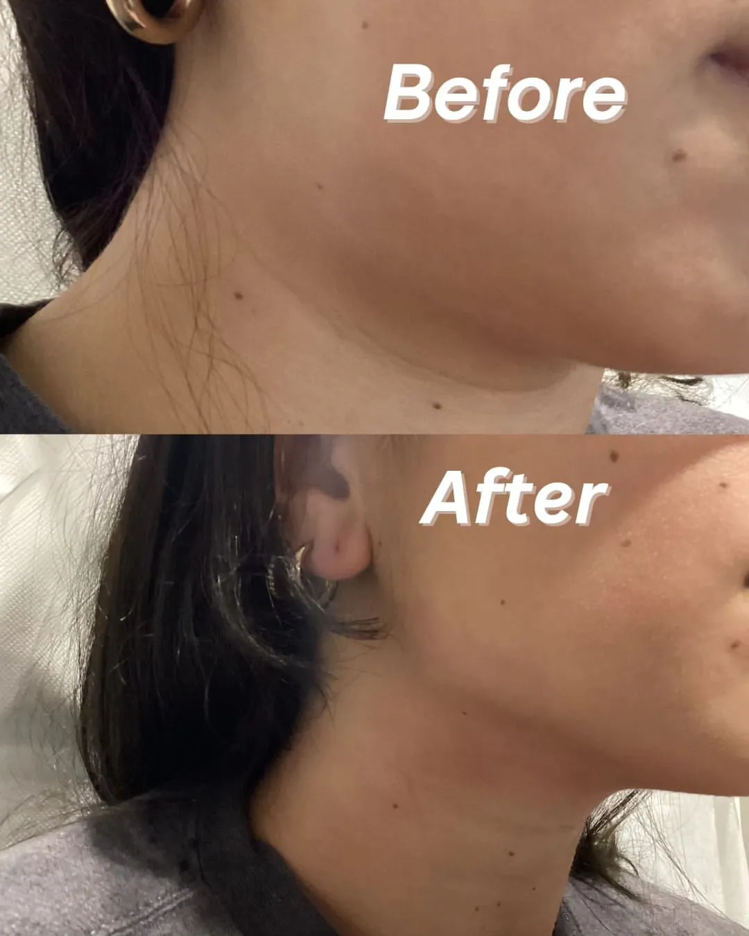 radio-frequency cynasure treatment 1