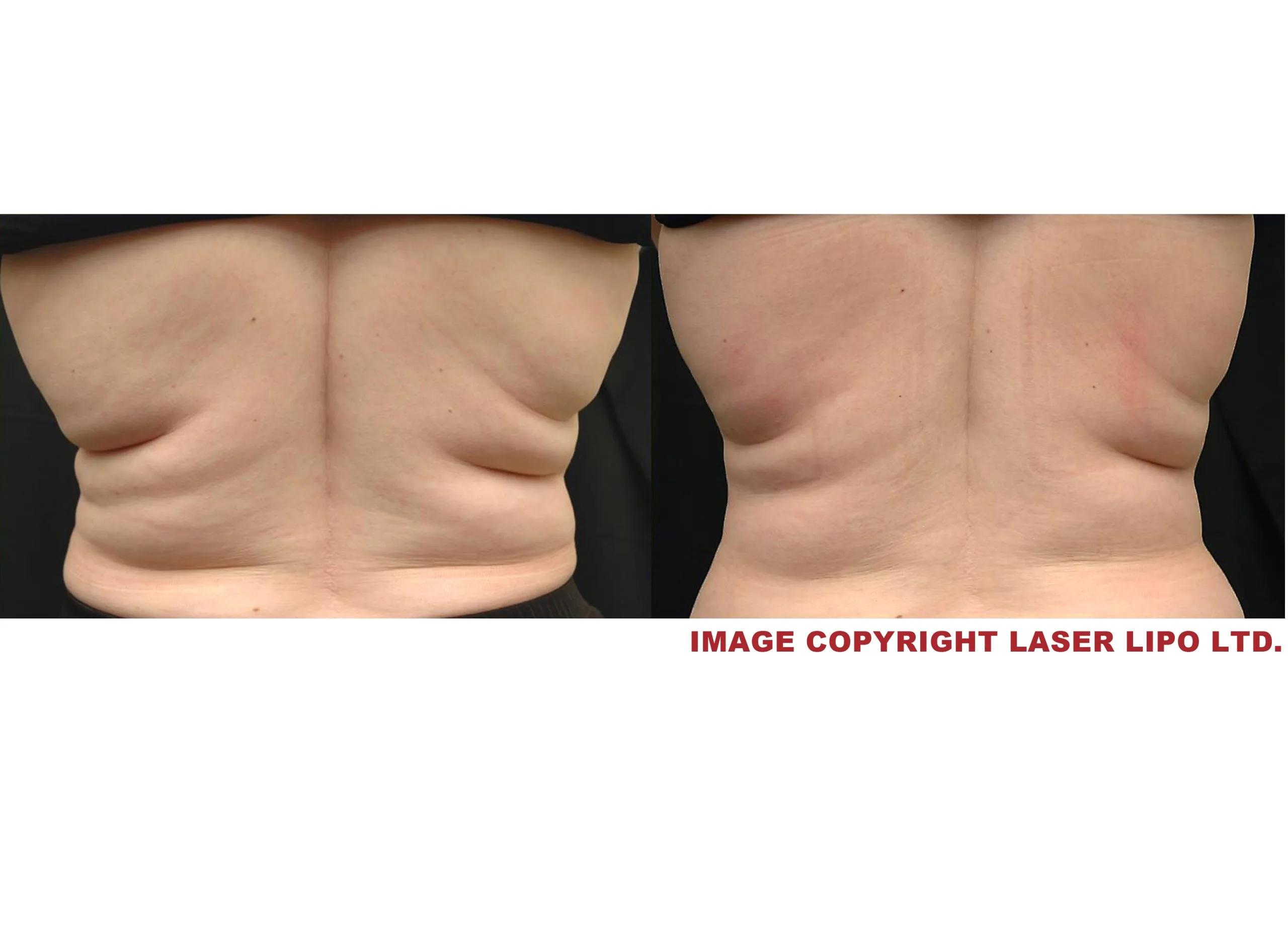 B4 & After female back