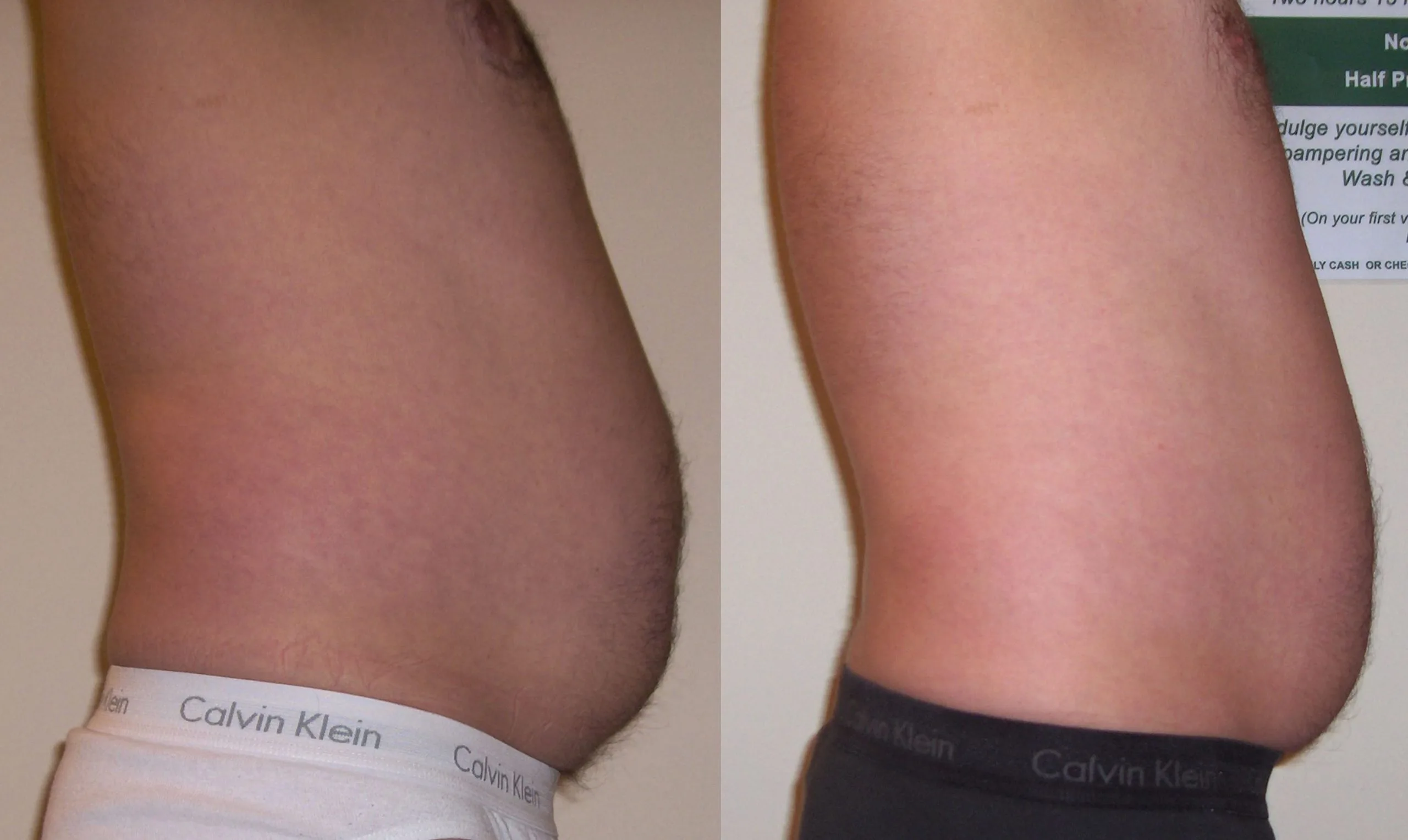 Before & after Male