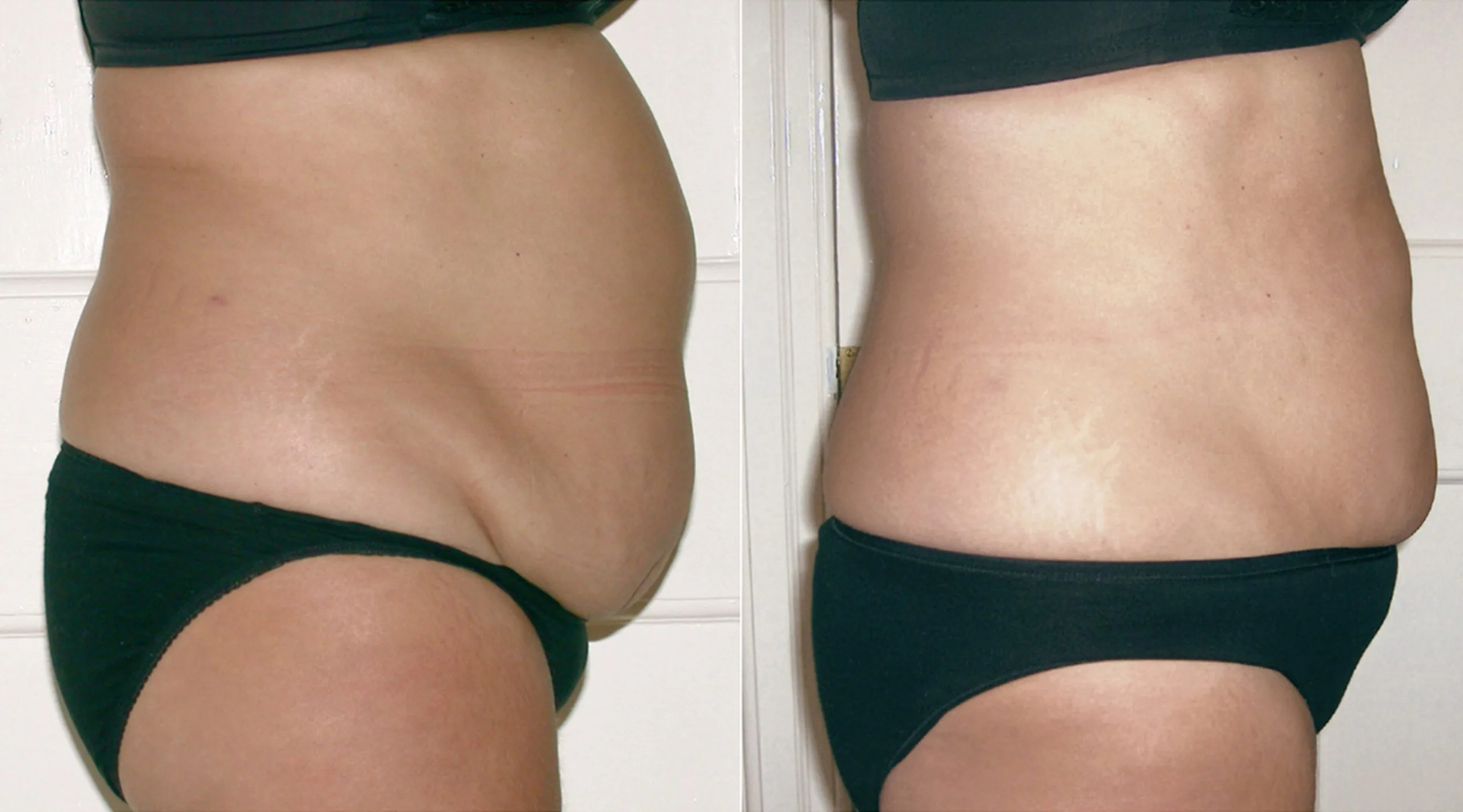 Inch Loss Before and After 02