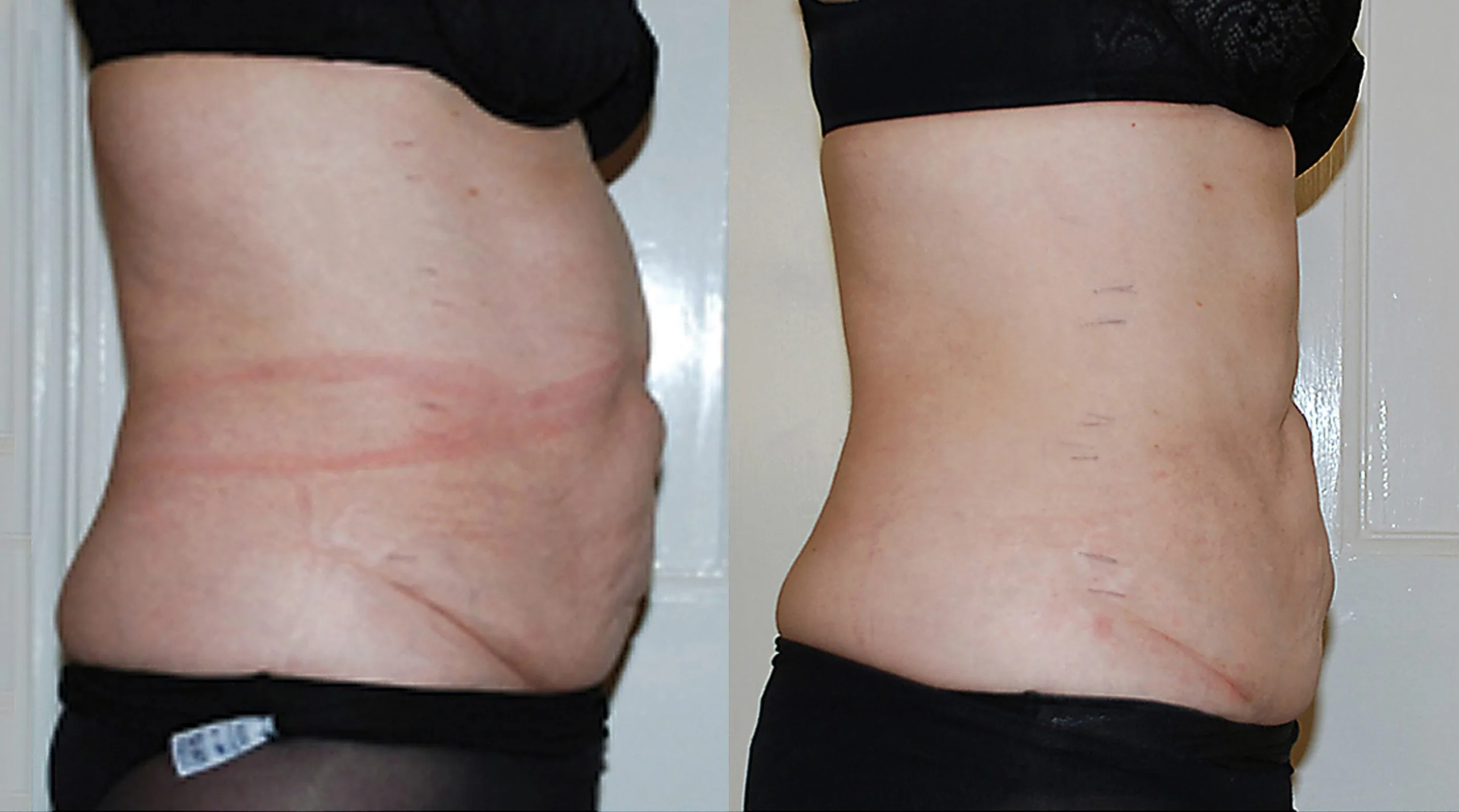 Inch Loss Before and After 03