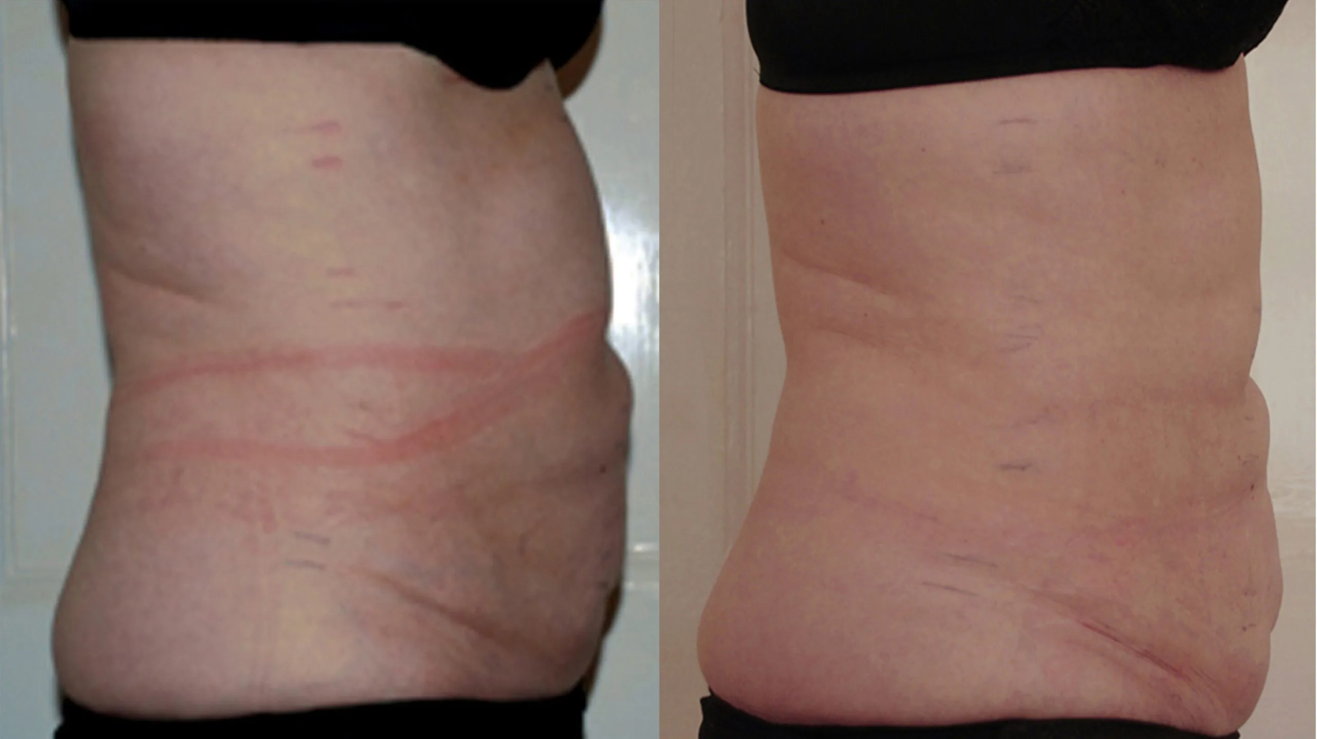 Inch Loss Before and After 04
