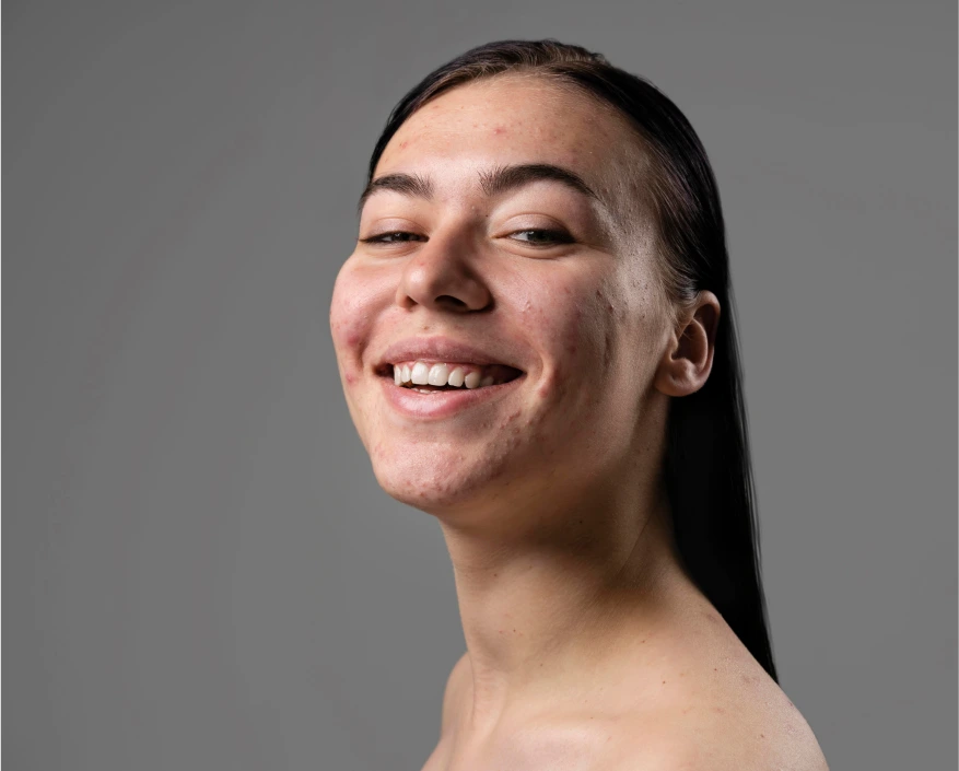 Facial Treatments in Marlboro, NJ: Acne Treatment Banner