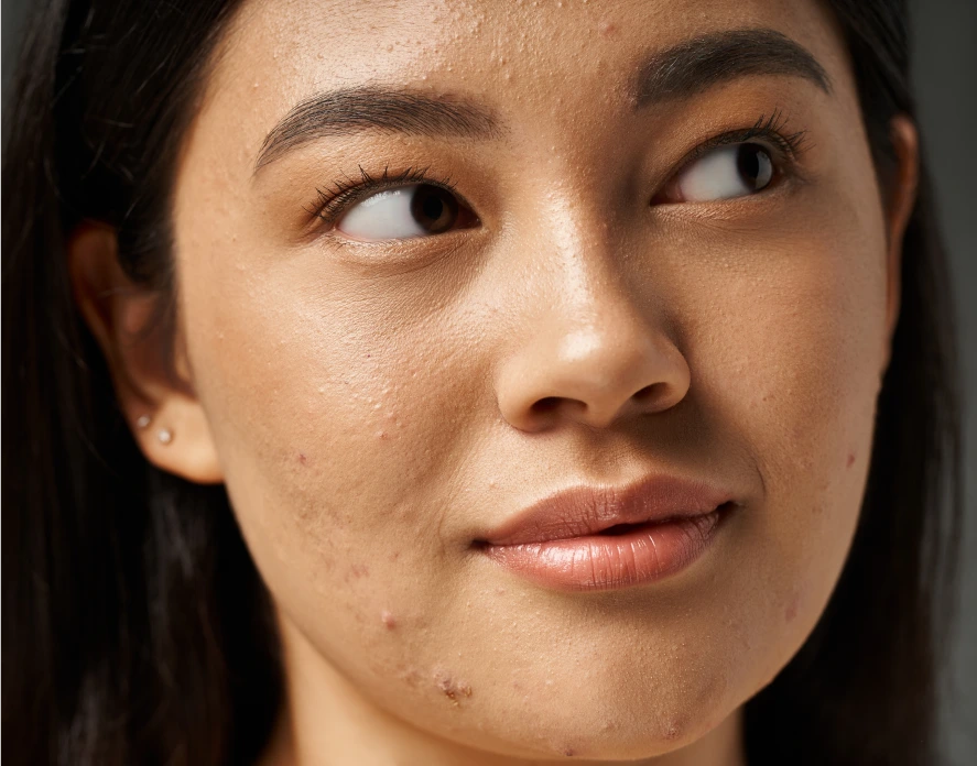 What Is Acne Treatment In Marlboro, NJ Banner